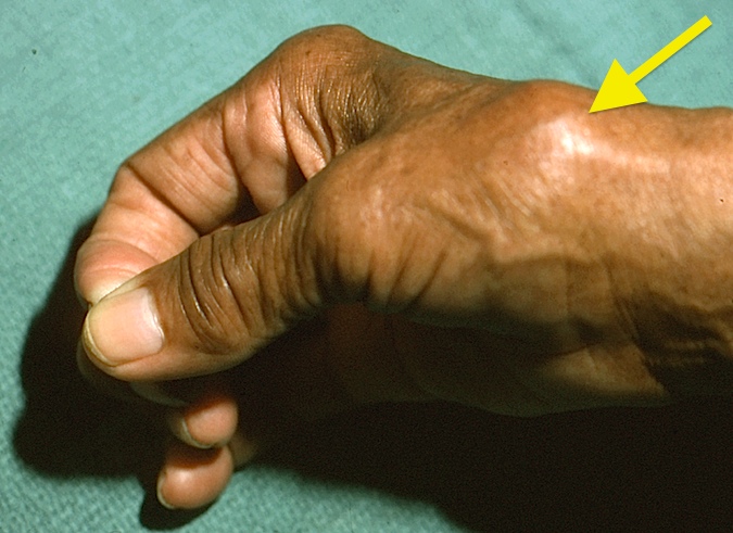 OSTEOARTHRITIS, CARPOMETACARPAL (CMC) JOINT OF THUMB